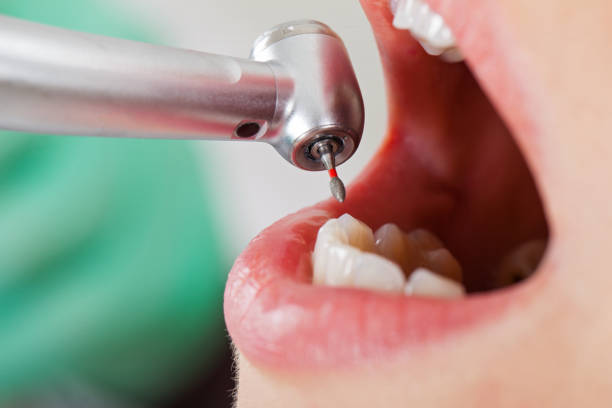 Best Emergency Tooth Extraction in Oskaloosa, KS